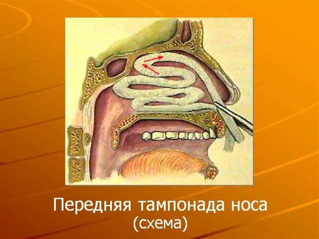 Тампонада носа при носовом кровотечении. Передняя тампонада носа. Передняя тампонада полости носа. Глубокая тампонада носа.