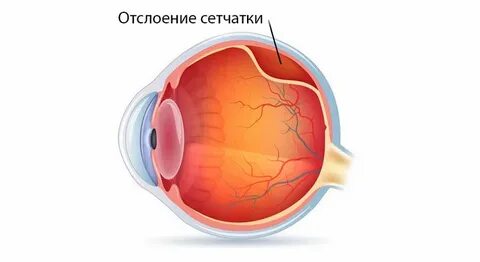 Виды отслойки сетчатки