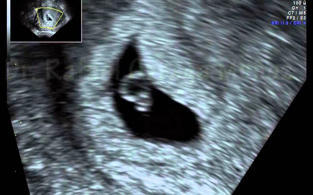 узи на 5 неделе беременности. эмбрион 5 6 недель беременности узи. узи на 4-5 неделе беременности акушерской. узи беременности 4 недели беременности. размер зародыша на 5 неделе.