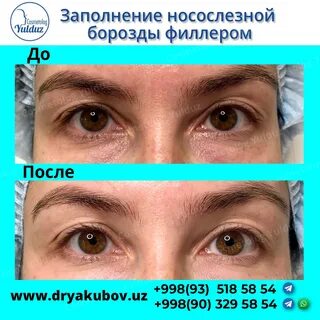Заполнение борозды