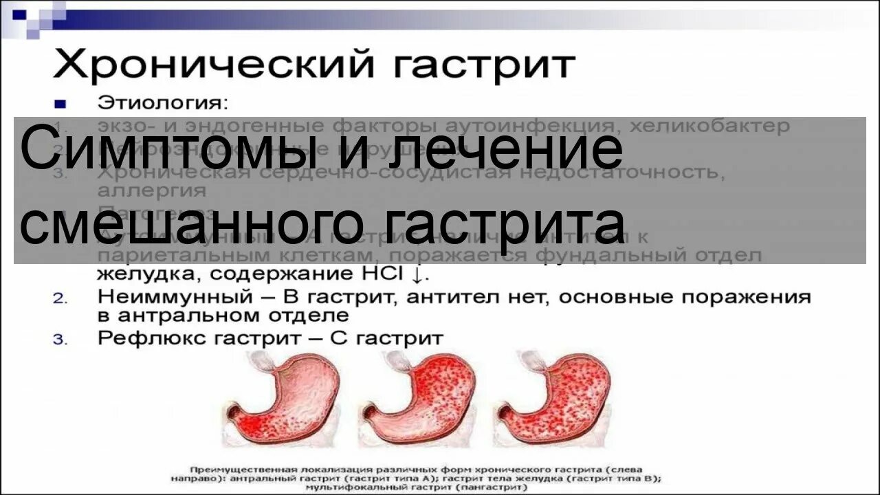 Хронический смешанный гастрит.