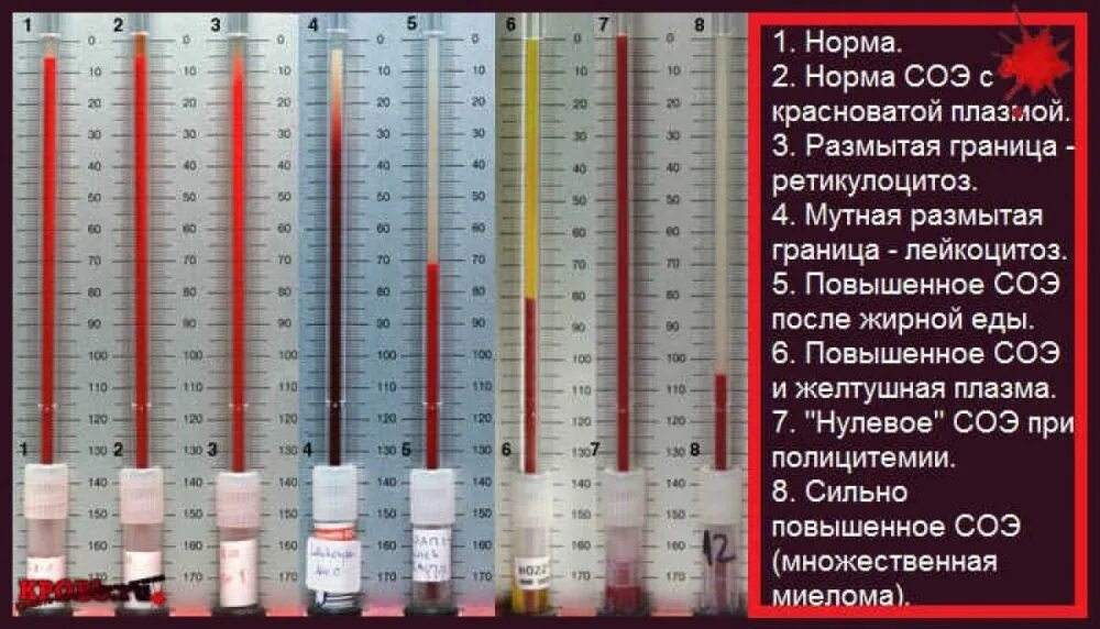 Что значит соэ в крови у женщин. Скорость оседания эритроцитов СОЭ норма. Метод Панченкова СОЭ. СОЭ метод Панченкова норма у женщин. СОЭ 11мм.