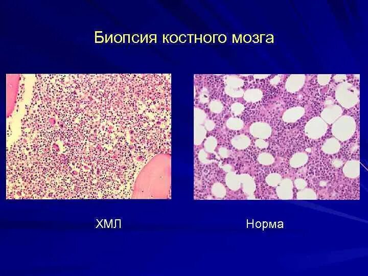 Хронический миелолейкоз костный мозг микропрепарат. Хронический миелобластный лейкоз гистология. Миелоидный лейкоз гистология. Миелобластный лейкоз гистология.