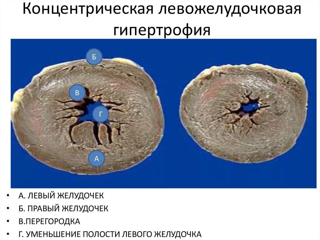 Концентрическая гипертрофия миокарда лж. Гипертрофия левого желудочка макропрепарат. Концентрическая и эксцентрическая гипертрофия левого желудочка. Концентрическая и эксцентрическая гипертрофия левого желудочка. Типы гипертрофии миокарда.