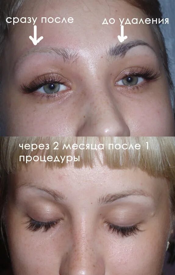 Перманентные брови как удалить. Выведение татуажа бровей лазером. удаление татуажа бровей лазером. брови после лазера. брови после снятия татуажа лазером.