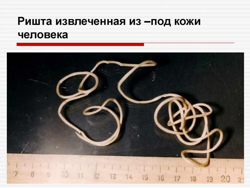 Какой гельминт является возбудителем дракункулеза. Круглые черви паразиты ришта. паразит гельминтоза ришта.