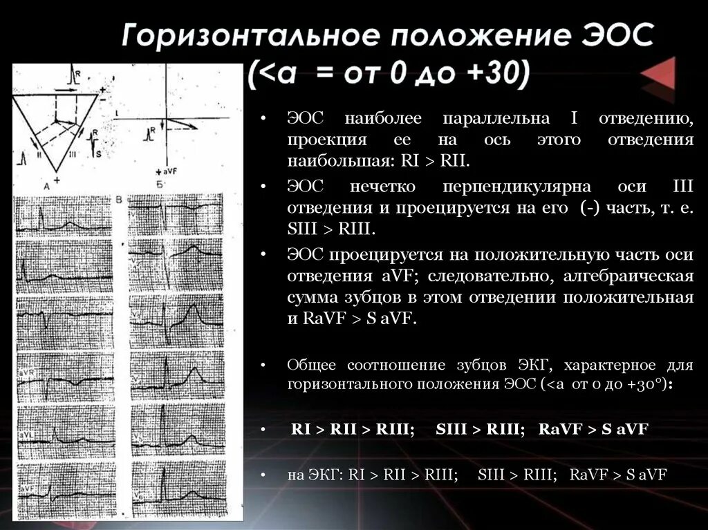 При ЭКГ электрическая ось горизонтальная. Горизонтальная электрическая ось сердца на ЭКГ. Положение электрической оси ЭКГ. Горизонтальное положение ЭОС на ЭКГ. Признаки горизонтали