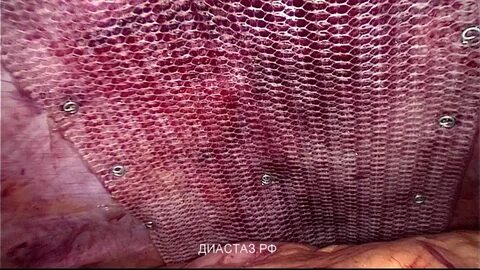 Операция сетка на брюшную полость