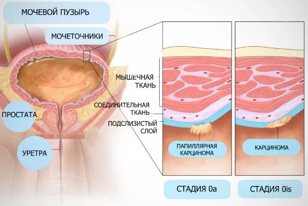 Как выглядит рак уретры у женщин Мочеиспускательный канал тест