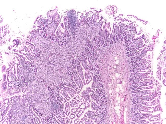 Дивертикулез кишечника гистология. Дивертикул толстой кишки гистология. Дивертикул толстой кишки гистология патологическая анатомия. Дивертикулез толстой кишки гистология патанатомия.