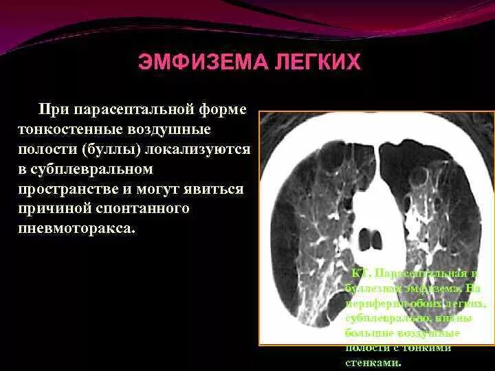 Субплевральные отделы легких. Парасептальная буллезная эмфизема. Буллезная эмфизема легких кт. Эмфизема легкого кт парасептальная.