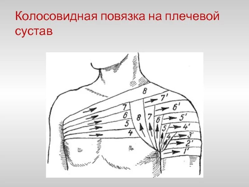 Техника наложения повязки на плечо. Колосовидная повязка техника наложения. Технику наложения колосовидной повязки на плечо. Наложение колосовидной повязки на плечевой сустав. Перевязка колосовидная на плечо.