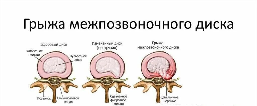 Экструзия межпозвоночного диска у собак. Экструзия межпозвонкового диска у собак. Грыжа позвоночника экструзия диска.