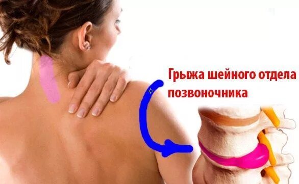 Грыжа шейного отдела диска с2-с3. Грыжа c5 c6. Грыжа с6-с7 шейного отдела на мрт. Вентральная грыжа позвоночника мрт. Позвоночная грыжа шейного отдела.