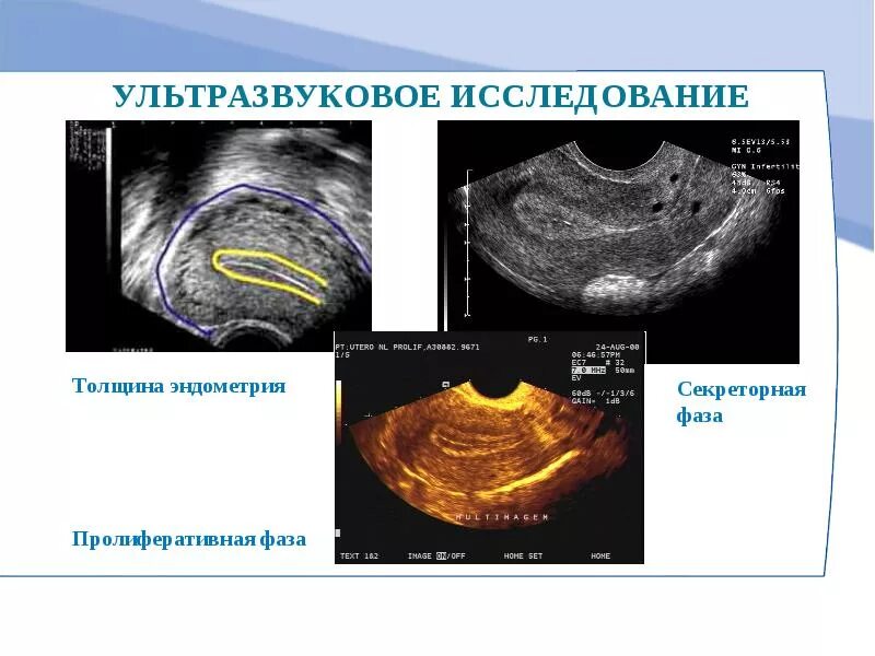 Толщина эндометрия на УЗИ норма. Трехслойная структура эндометрия (УЗИ). Эндометрий толщина УЗИ норма. Эндометрий толщина по УЗИ норма. Эндометрий 14 день