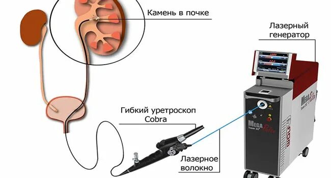 Лазерная контактная литотрипсия камня мочеточника. Ультразвуковое дробление камней. Ультразвуковая литотрипсия. Ультразвуковое дробление камней в почках.