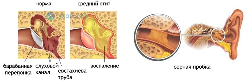 Тубоотит барабанная перепонка. Наружный отит серная пробка. Серные пробки в евстахиевой трубе. Вода попала в ухо через нос