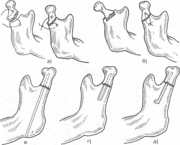 Венечный отросток нижней челюсти. Перелом мыщелкового отростка нижней челюсти осложнения. Перелом отростка нижней челюсти лечение. Классификация перелома нижней селюсти. Перелом мыщелкового отростка нижней челюсти лечение.