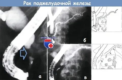 Опухоль на поджелудочной железе операция