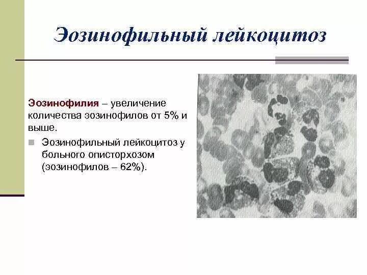 Эозинофильный лейкоцитоз. Лейкоцитоз эозинофилия. Лейкоцитоз моноцитоз эозинофилия. Причины эозинофильного лейкоцитоза. Эозинофильный и базофильный лейкоцитоз..