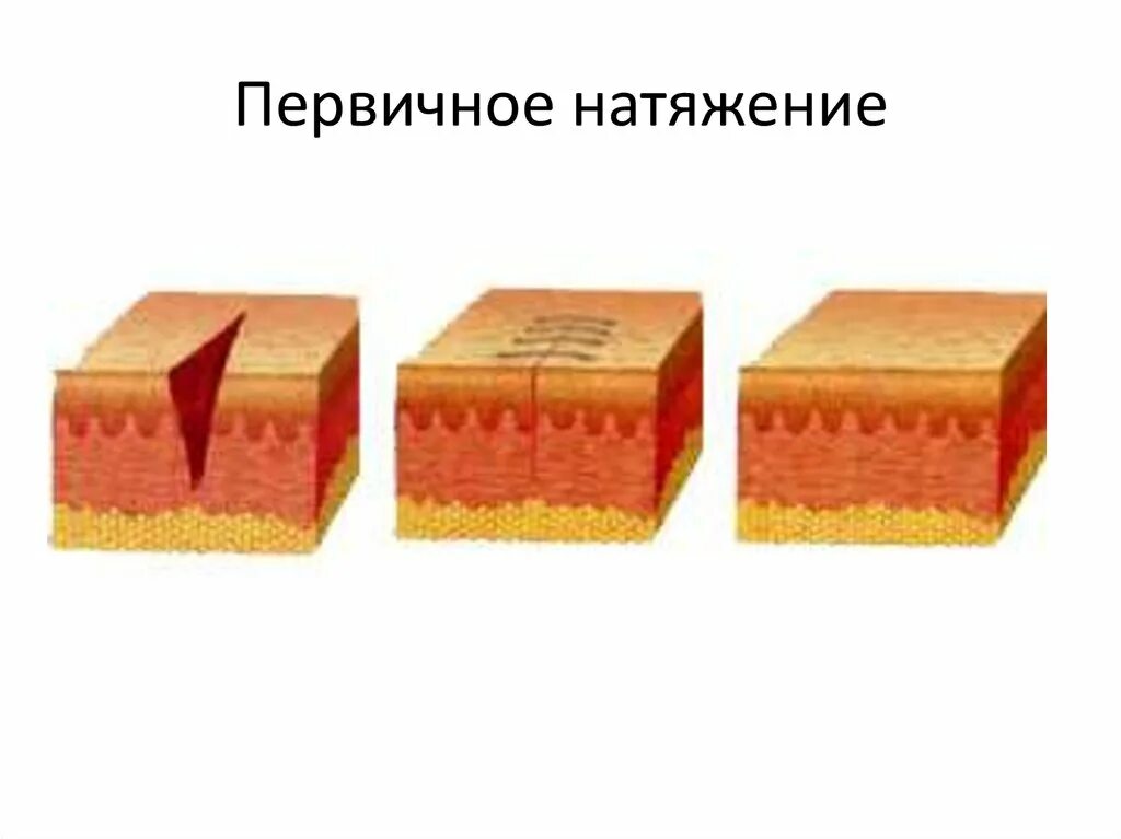Заживление ран вторичным натяжением. Заживление ран первичным натяжением. первичное и вторичное натяжение заживление ран. первичное заживление раны хирургия.