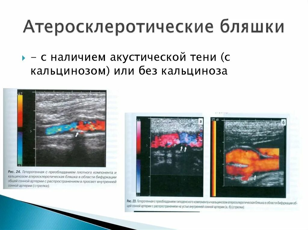 Атеросклеротическая бляшка узи. Кальцинированная атеросклеротическая бляшка. гиперэхогенная бляшка. типы атеросклеротической бляшки.