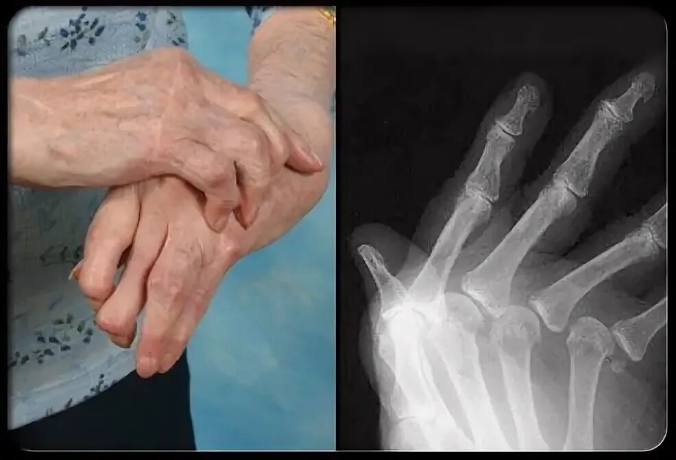 File:Gout Comparison.jpg - Wikipedia