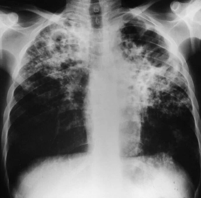 Поражение органов туберкулезом. Снимки туберкулеза легких. Туберкулез tuberculosis