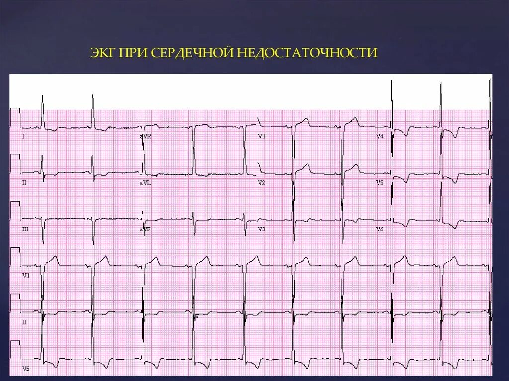 Тест на сердечную недостаточность. Хроническая сердечная недостаточность на ЭКГ. Кардиограмма сердечной недостаточности. ЭКГ при хроническая сердечная недостаточность. Изменения на ЭКГ при ХСН.