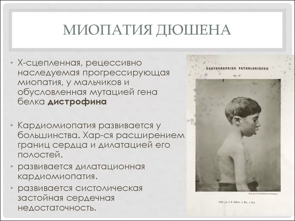 Миопатия что это за болезнь. Симптомы поражения при миопатии Дюшенна:. Мышечная дистрофия Дюшенна причины. Псевдогипертрофическая мышечная дистрофия Дюшенна дистония. Миопатия клинические проявления.