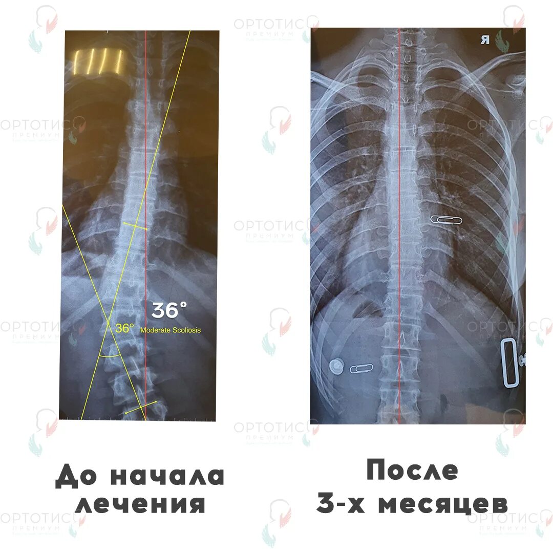 Сколиоз 2 степени 17 градусов. Искривление позвоночника 17 градусов.