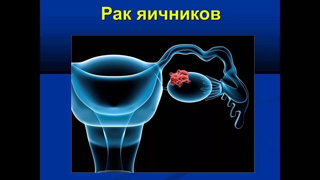 Онкология яичников у женщин. Онкология яичников наследственные. Циторедукция. Рак яичников причины