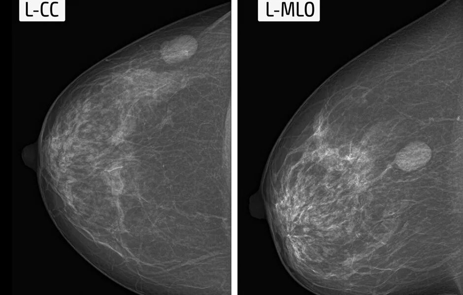 Фиброма в груди. Фиброаденоз маммография. Фиброаденома молочной железы маммограмма. Фиброаденоматоз молочной железы рентген. Фиброаденома молочной железы маммография.