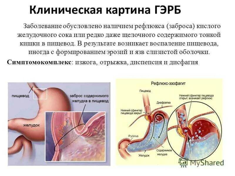 Желудочный сок в пищеводе