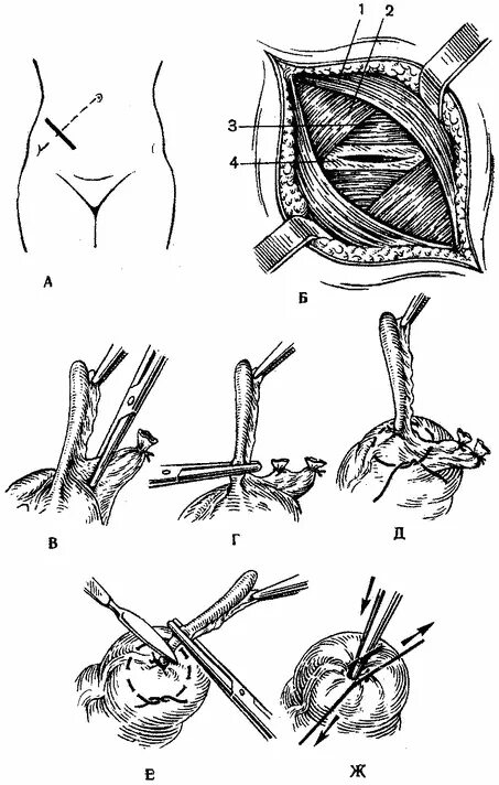 Какое лапаротомия. Лапаротомия аппендэктомия. Аппендэктомия Оперативная хирургия. Лапаротомия брюшной полости шрам. Аппендэктомия этапы операции.
