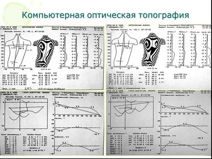 Оптическая топография