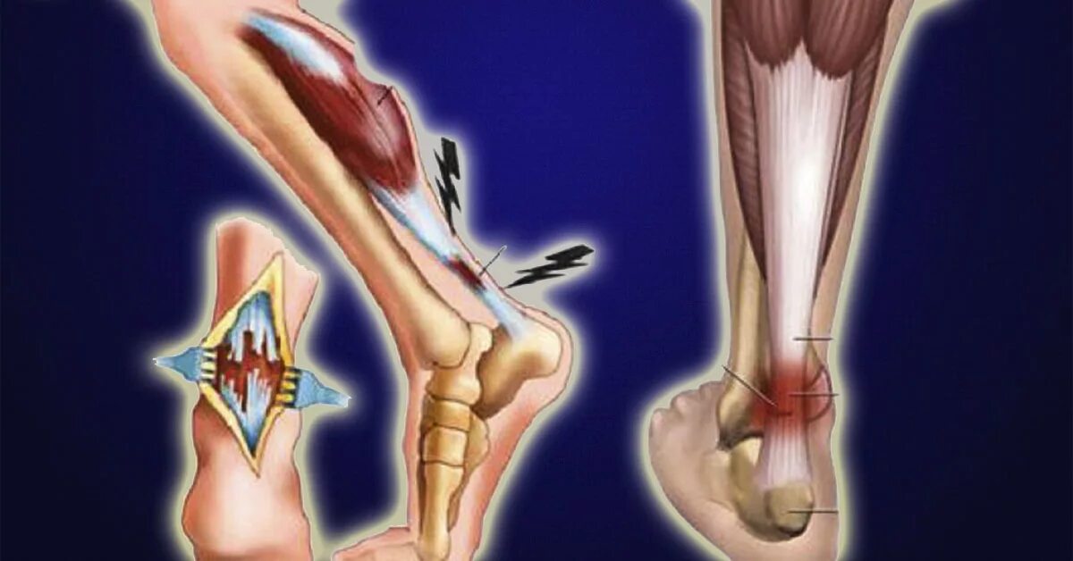 Сколько заживает сухожилие. Разрыв связок и сухожилий. Разрыв мышц связок сухожилий первая помощь. Тендинит ахиллова сухожилия рентген. Растяжение и разрыв связок.
