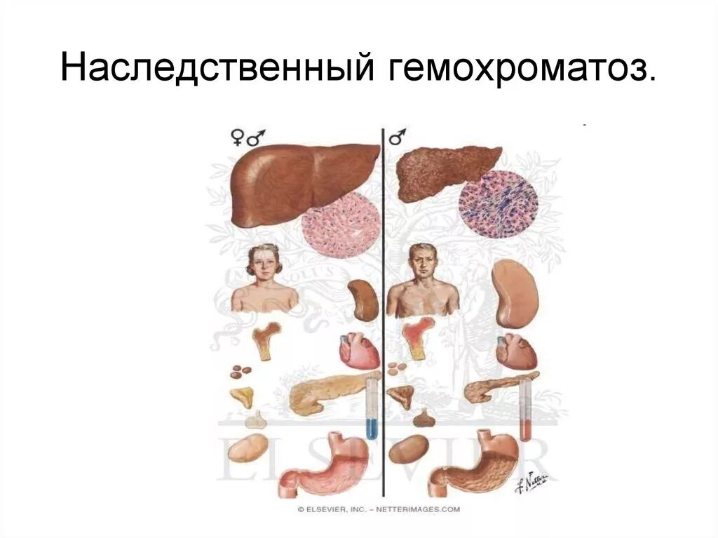 Гемохроматоз признаки. Гемохроматоз печени этиология. гемохроматоз этиология патогенез. наследственный гемохроматоз. первичный гемохроматоз.