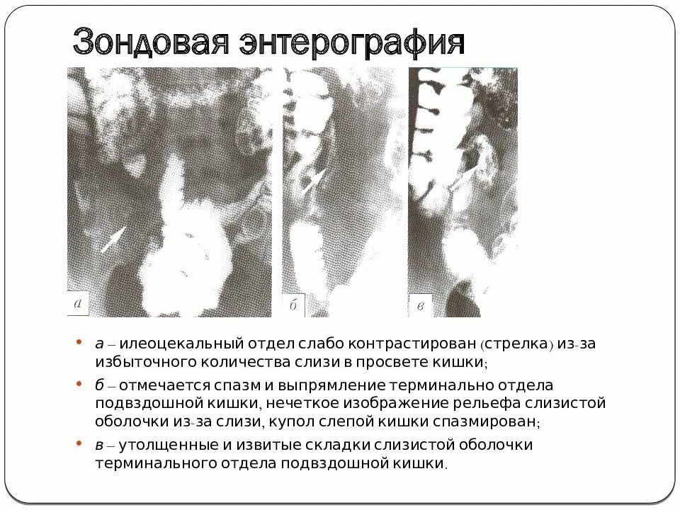 Энтерография сделать. Зондовая энтерография. кт энтерография тонкого кишечника. зондовая энтерография тонкого кишечника. энтерография кишечника что это такое.