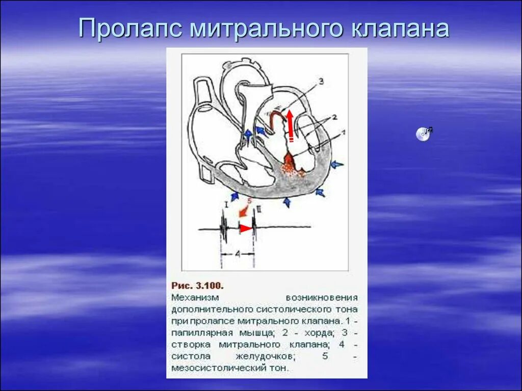 Что такое пролапс митрального клапана. Синдром пролапса митрального клапана. Пролапс митрального клапана шум. Митральный клапан функции. Пролапс митрального клапана патогенез.