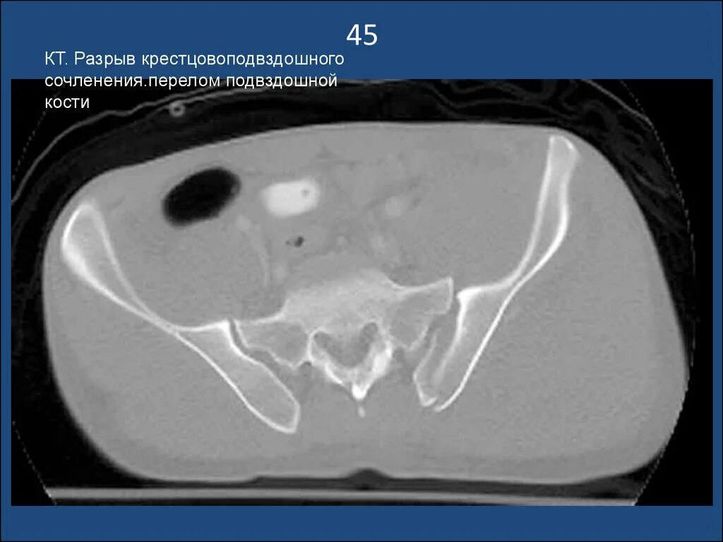Кт подвздошной кости. Перелом подвздошной кости кт. Перелом крыла подвздошной кости кт. Кт трещина подвздошной кости. Киста крыла подвздошной кости кт.