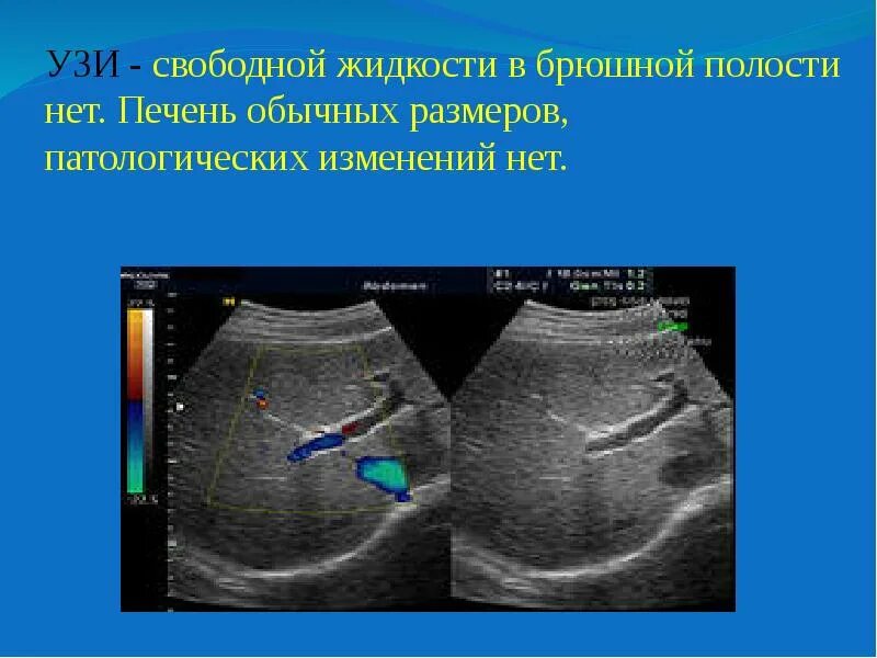 Асцит (скопление свободной жидкости в брюшной полости). Свободная жидкость асцит УЗИ. Свободная жидкость в брюшной полости на УЗИ.