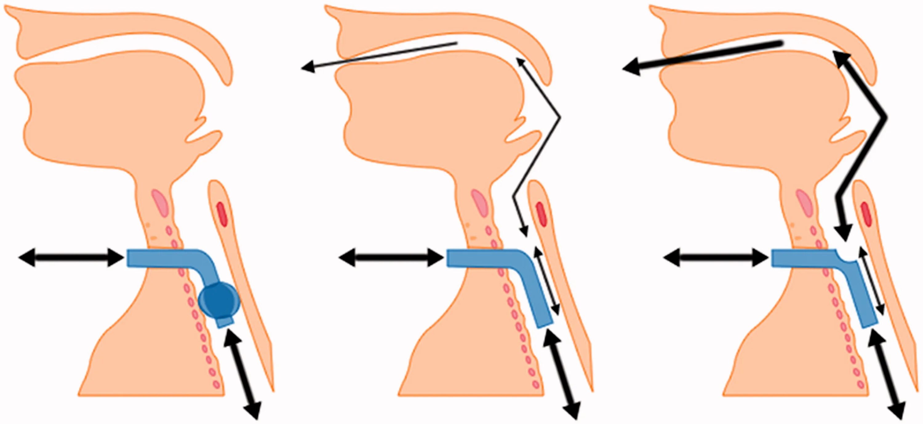 Эндотрахеальное введение адреналина у детей. Эндотрахеальный путь введения. Трубка в трахею. Трубка в трахею. Интубация трахеи алгоритм.