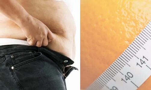 целлюлит у мужчин бывает. целлюлит у мужчин. целлюлит у мужчин. мужской целлюлит на животе. жир на боках у мужчин.