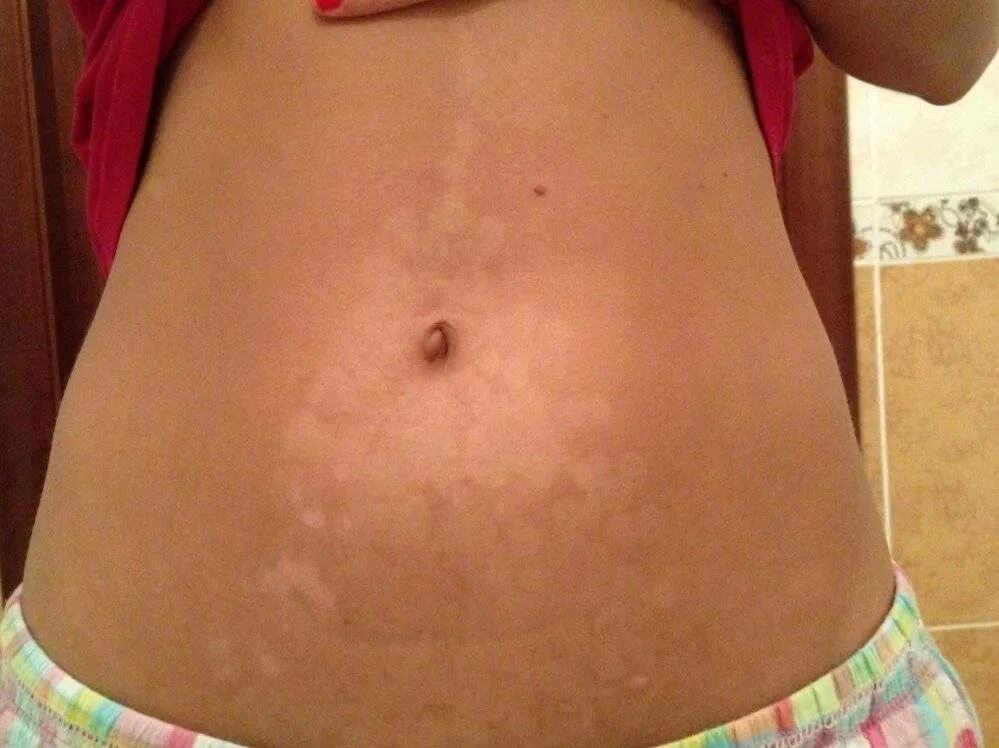 Беременность для кожи лица. Атопический дерматит клинические проявления. Акне инфографика. Высыпания на лице у беременной. Ожоги после лазерной эпиляции.