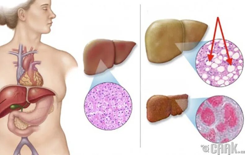 Чем опасна жировая печень. Болезнь печени жировой гепатоз. Неалкогольный гепатоз. Жировой гепатоз симптомы. Жировой гепатоз беременных.