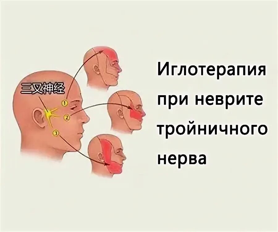 Иглоукалывание лицевой нерв. Неврит лицевого нерва рефлексотерапия. Акупунктура при невралгии тройничного нерва. Иглоукалывание при неврите лицевого нерва. Иглотерапия при неврите тройничного нерва.