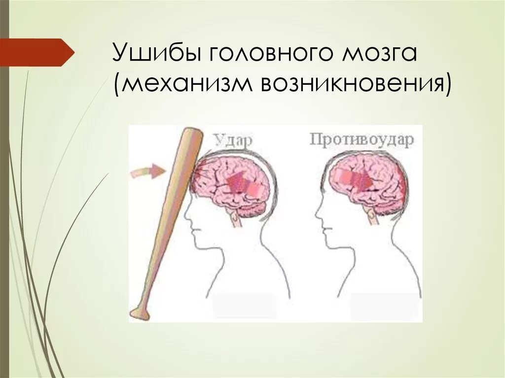 Сотрясение мозга до года. Ушиб головного мозга механизм травмы. Черепно-мозговая травма сотрясение головного мозга. Травмы головного мозга у детей.