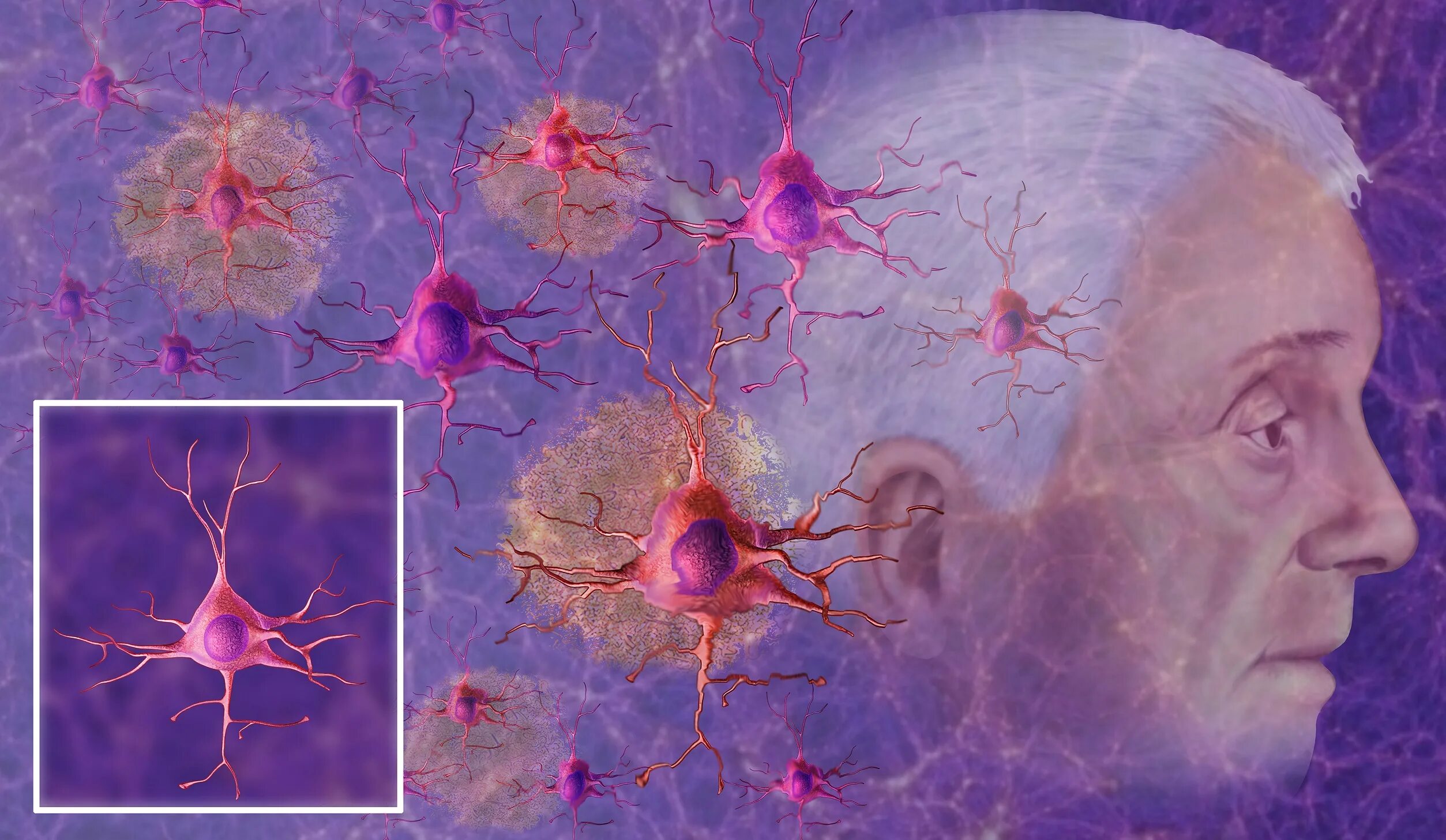 Дегенерация нейроглии. Болезнь Альцгеймера Нейроны. Болезни нервной системы Альцгеймера. Старение нервных клеток.