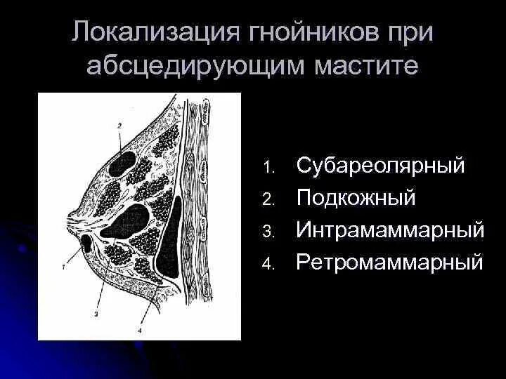 Интрамаммарный ретромаммарный. Интрамаммарный Гнойный мастит. Мастит подкожный субареолярный интрамаммарный. Ретромаммарный абсцесс.